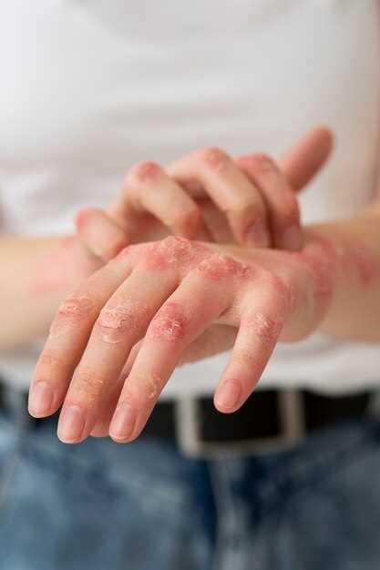 Причины возникновения дерматита на руках