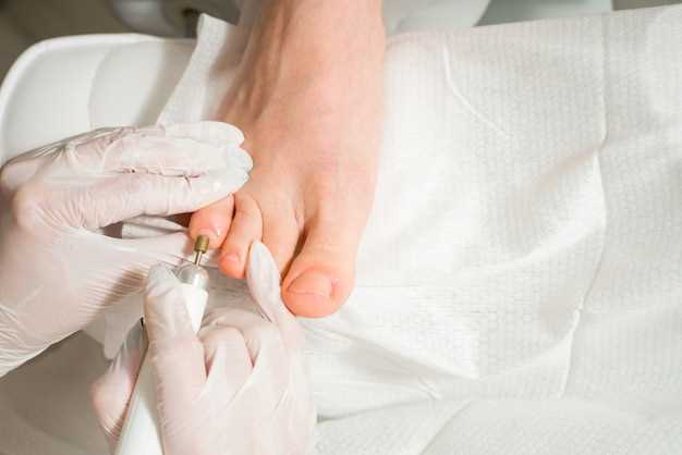 Различные методы лечения грибка на ногтях
